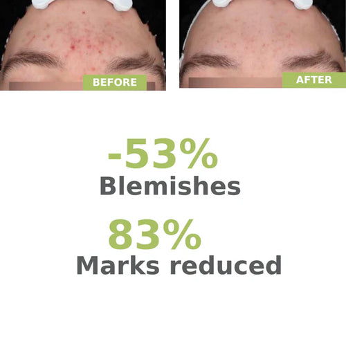 A-derma Biology AC Night Peel Serum 30ml